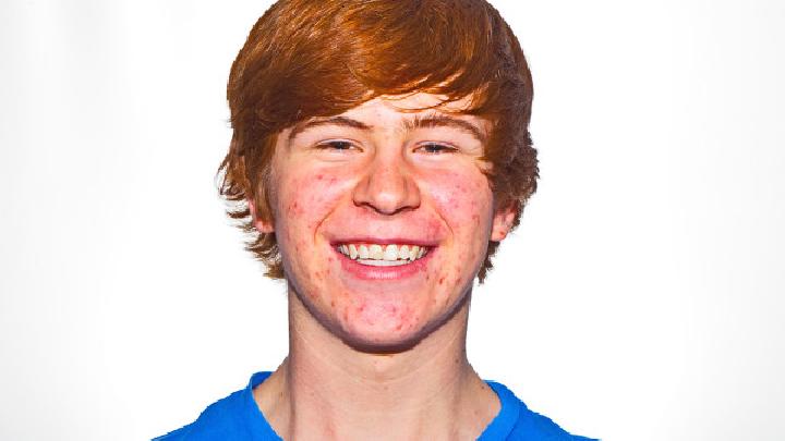 异维a酸祛痘效果怎么样？异维a酸祛痘的正确方法是什么？