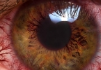 眼部的黑眼圈是怎么形成的? 详细分析眼部黑眼圈的成因