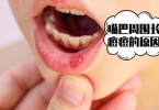 八大去青春痘的方法帮你有效祛痘 祛除青春痘最好的方法