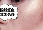 用白醋洗脸能去痘印吗 白醋洗脸的好处是什么