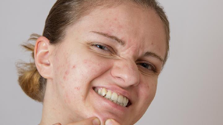 女生背上长痘痘的原因有哪些？背上长痘痘如何去除？
