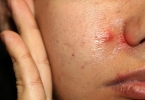 脸上痘痘里挤出的乳白色物是什么？脸上长痘的人注意这4点常识