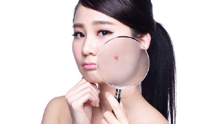 头发里头皮上长痘痘怎么办？祛痘方法有哪些？