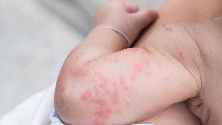 青少年如何预防青春痘？青春痘预防最好的方法