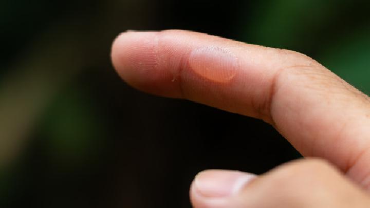 什么面膜祛痘美白效果好？自制祛痘美白面膜