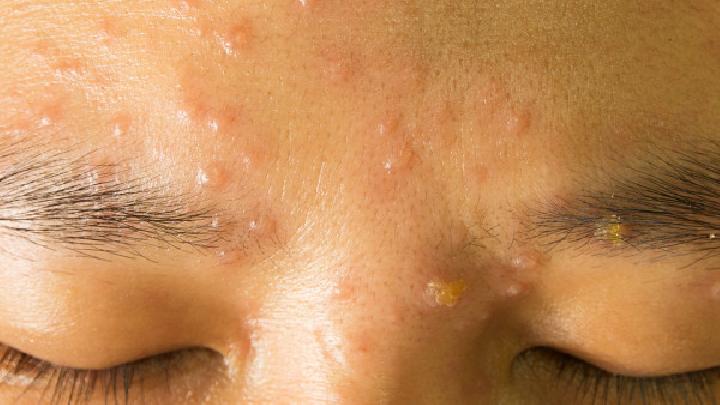 脸上青春痘疤痕如何去除？盘点6种去除痘痕的方法