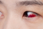 被同学传染红眼病打了5天针也没有好，怎么办？