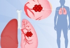 肺结核好治吗？能彻底治好吗