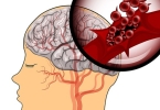 脑出血恢复期间多久查一次CT