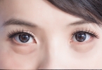 眼里长翼状胬肉斜视