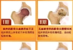 股骨头坏死选择中医保髋还是西医置换？看这篇就对了