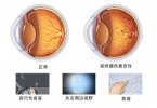 不治绝症≠无药可医 视网膜色素变性延缓病情才是目标
