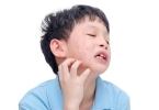 被蚊虫咬了极痒又肿怎么办