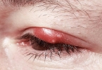 甲状腺肿瘤能活多久