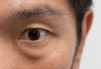 眼皮发炎会影响视力吗？