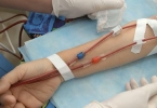 双侧肾坏死还能存活吗