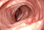 前庭大腺囊肿术后性生活：恢复好坏如何影响你的幸福？