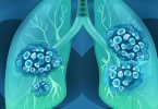 输尿管肿瘤治疗：手术并非唯一选择，如何量身定制你的健康方案？
