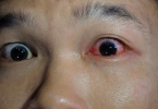 一直眨眼睛经常用手去擦眼睛