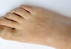 手足口接触后怎么补救