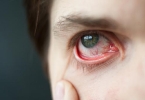 黄斑前膜手术后恢复期要封眼吗