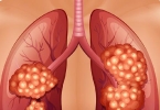 左肺上部纤维化是什意思
