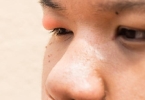 麦粒肿半年了一直不消怎么办