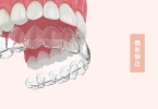 做牙齿矫正手术时间是多久？