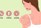 先天性梅毒牙的临床表现是什么