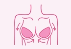 20岁乳房吸出乳汁正常吗