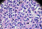 HIV腋下淋巴结肿大的特点解析