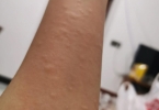 皮肤过敏症原因是什么