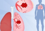 磨玻璃结节中有空气管征很可能是早期肺癌