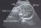 孩子小脑第四脑占位严重吗