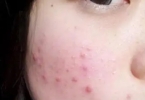 腿上的毛囊炎是什么引起的