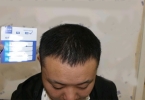 40多岁适合植发吗
