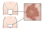 尖锐湿疣患者如何避免感染家人