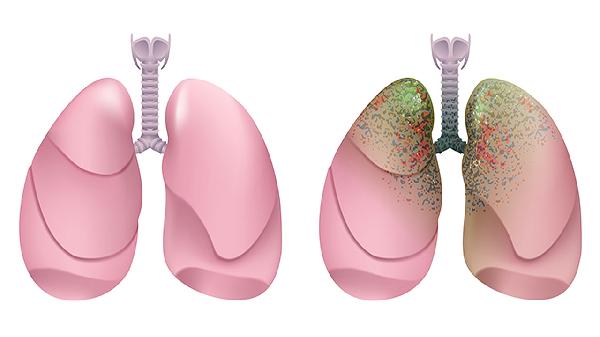 鼻部肿瘤手术后咳嗽伴有头痛怎么办呀