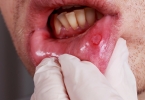 口腔溃疡反复发作？超过这个时间，当心癌症找上门