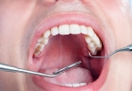 牙结石掉了牙龈空了