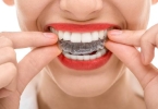 牙套可以只带一排吗
