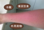 晒伤后皮肤起疙瘩奇痒怎么缓解