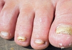 脚上的灰指甲是怎样形成的