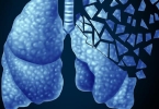 肺癌新增100万！一检查就是晚期！日常生活牢记“6不要”防肺癌！