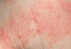 皮炎湿疹和荨麻疹的区别在哪