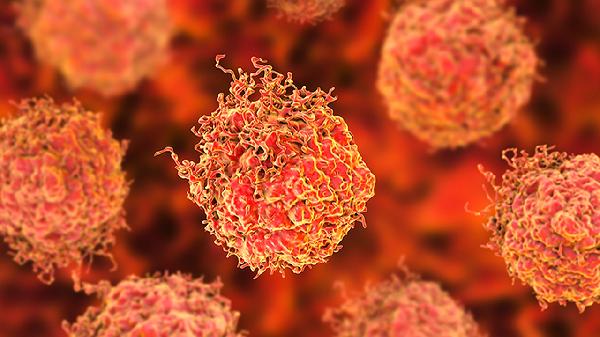 肺淋巴管肌瘤是癌症吗能治好吗