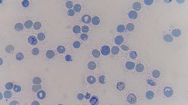 高血压和癌症有关系吗