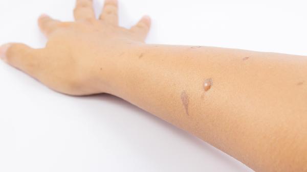 肺里有水泡要是破了有危险吗