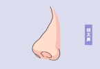 长了朝天鼻该怎么办才好
