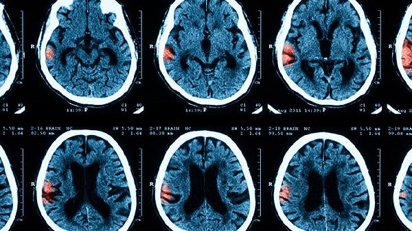 四个月宝宝脑膜炎症状